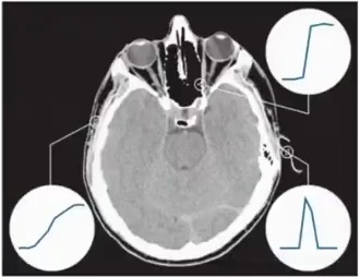 Medical brain scan image with circular insets showing different edge profile patterns
