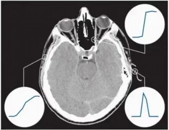 Medical brain scan demonstrating edge detection with noise sensitivity analysis